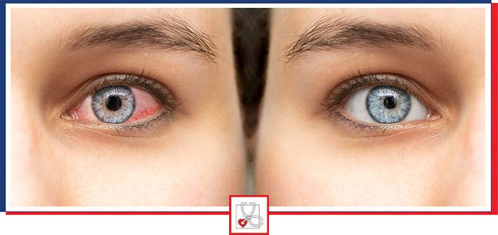 Pink Eye Treatment Clinic in Boca Raton, FL Pink Eye Treatment Clinic in Boca Raton, FL