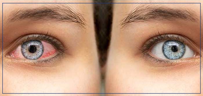 Pink Eye Treatment Clinic in Boca Raton, FL